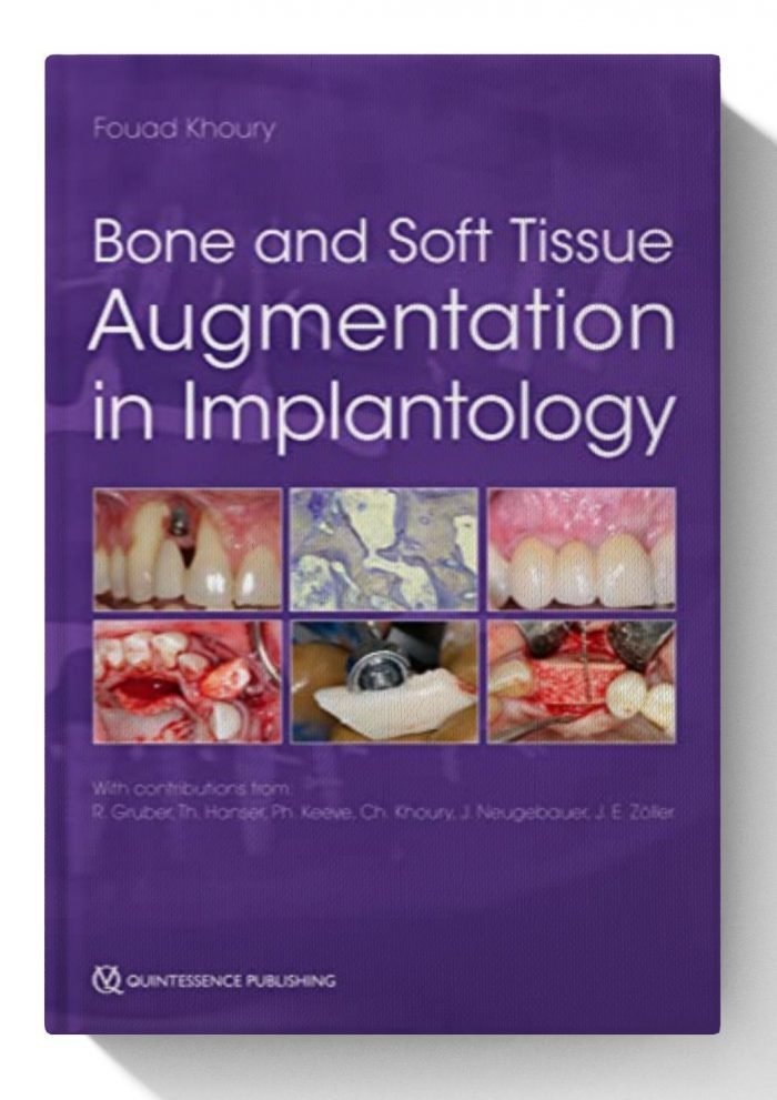 Bone and Soft Tissue Augmentation in Implantology